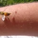 bee-stinger-1367388988